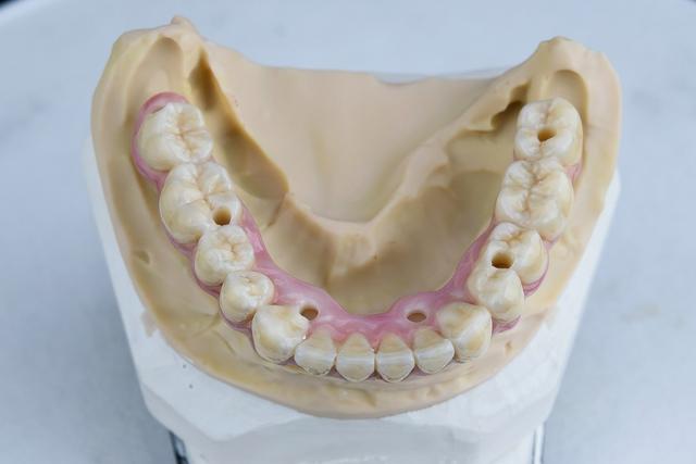 Na fotografiji su povoljno all on 6 fiksni zubi u 24 sata na Straumann implantatima