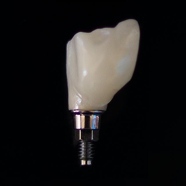 Vidi se samo krunica na vijak za Straumann implantat